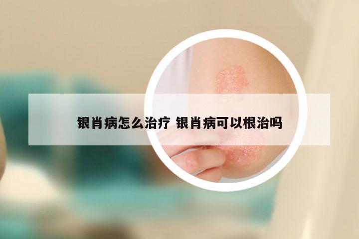 银肖病怎么治疗 银肖病可以根治吗
