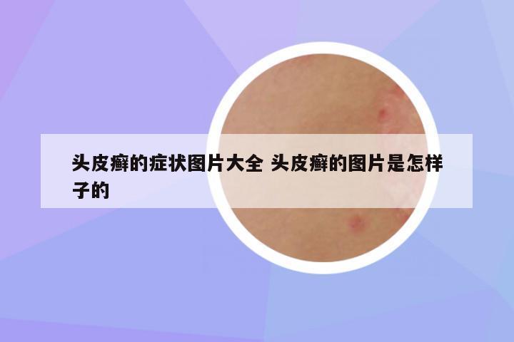 头皮癣的症状图片大全 头皮癣的图片是怎样子的