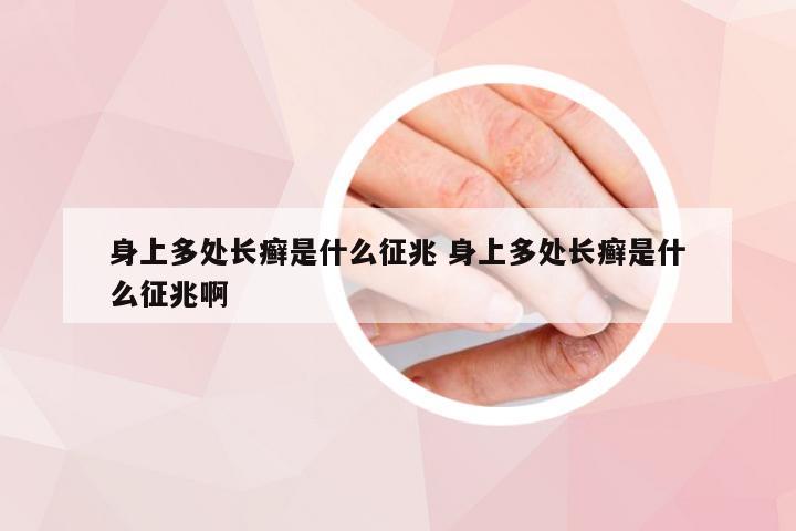 身上多处长癣是什么征兆 身上多处长癣是什么征兆啊