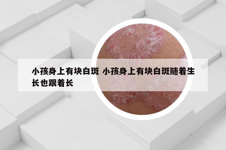 小孩身上有块白斑 小孩身上有块白斑随着生长也跟着长