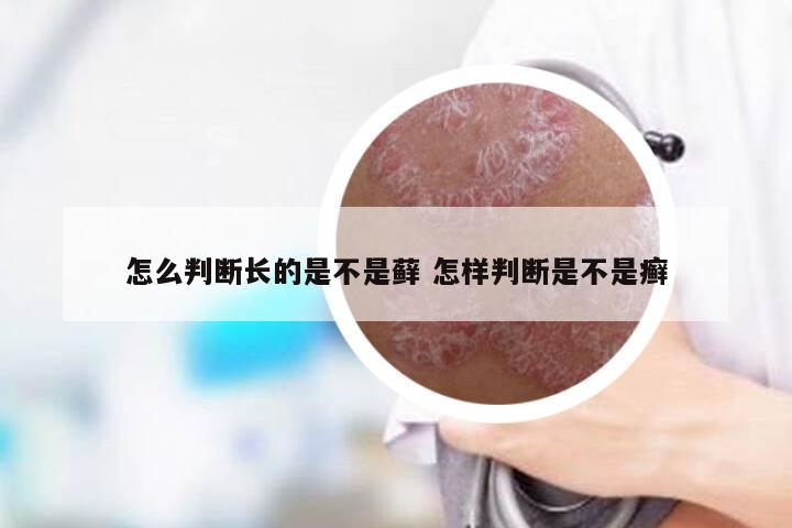 怎么判断长的是不是藓 怎样判断是不是癣