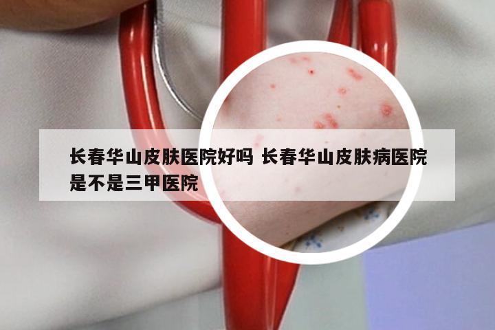 长春华山皮肤医院好吗 长春华山皮肤病医院是不是三甲医院