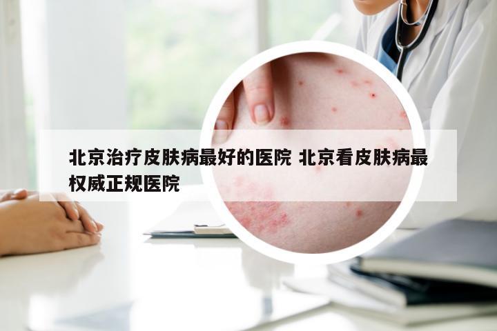 北京治疗皮肤病最好的医院 北京看皮肤病最权威正规医院