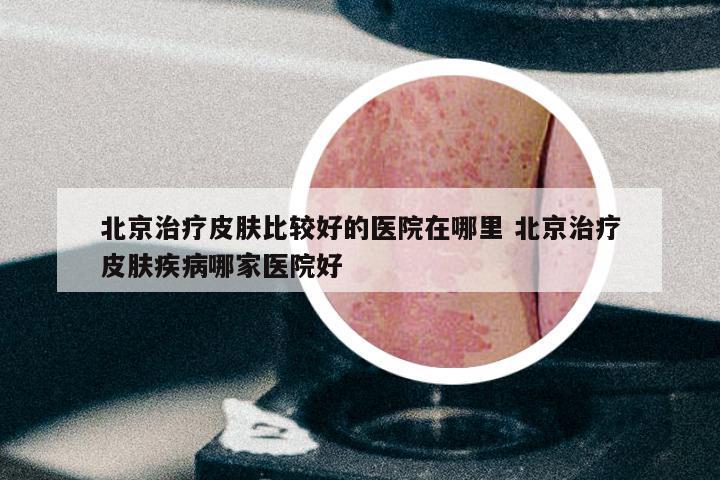 北京治疗皮肤比较好的医院在哪里 北京治疗皮肤疾病哪家医院好