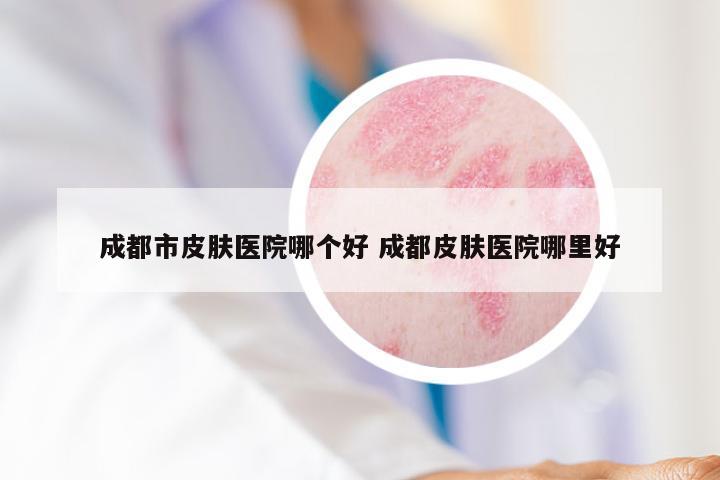 成都市皮肤医院哪个好 成都皮肤医院哪里好