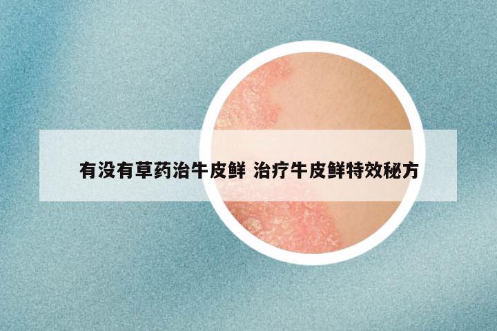 有没有草药治牛皮鲜 治疗牛皮鲜特效秘方