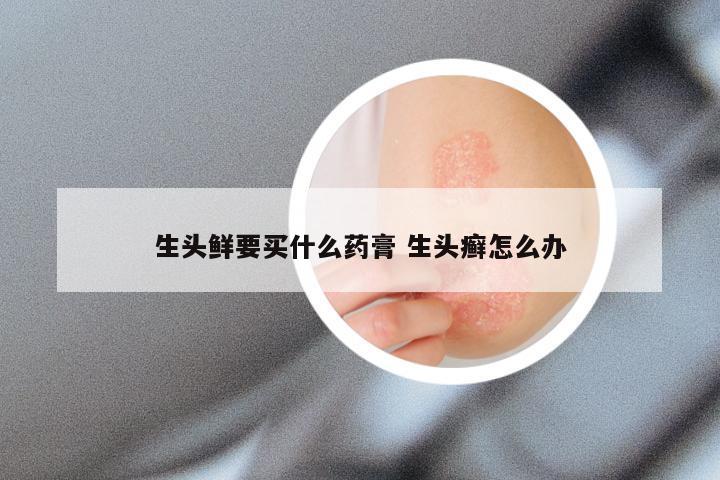 生头鲜要买什么药膏 生头癣怎么办