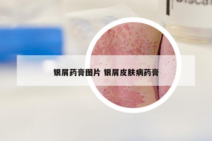 银屑药膏图片 银屑皮肤病药膏
