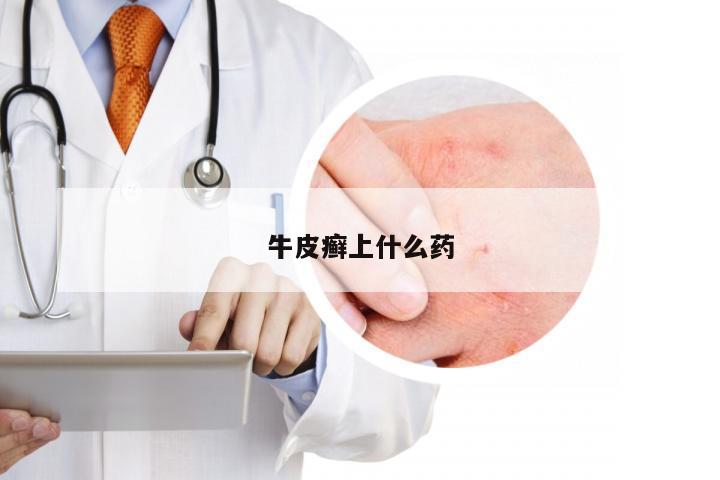 牛皮癣上什么药