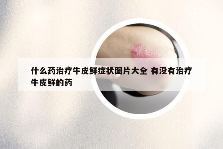 什么药治疗牛皮鲜症状图片大全 有没有治疗牛皮鲜的药