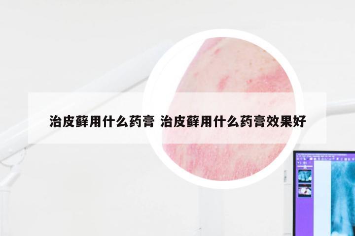 治皮藓用什么药膏 治皮藓用什么药膏效果好