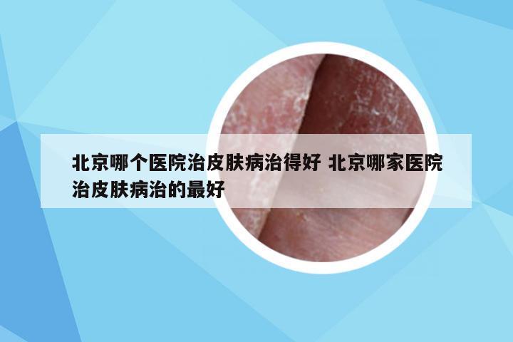 北京哪个医院治皮肤病治得好 北京哪家医院治皮肤病治的最好