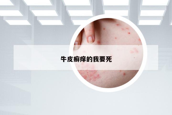 牛皮癣痒的我要死