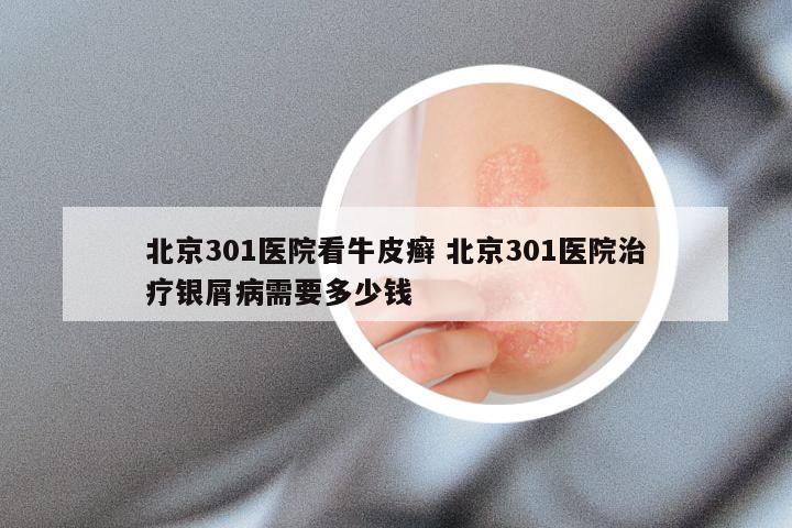 北京301医院看牛皮癣 北京301医院治疗银屑病需要多少钱