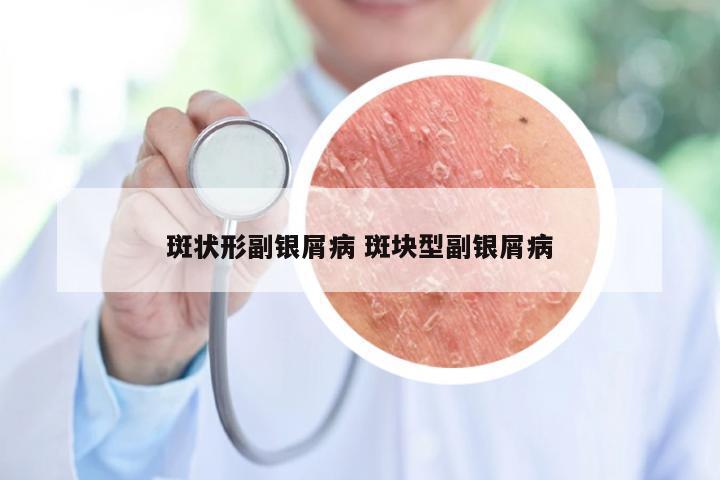 斑状形副银屑病 斑块型副银屑病