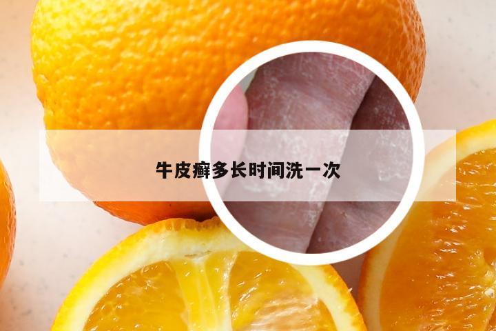 牛皮癣多长时间洗一次