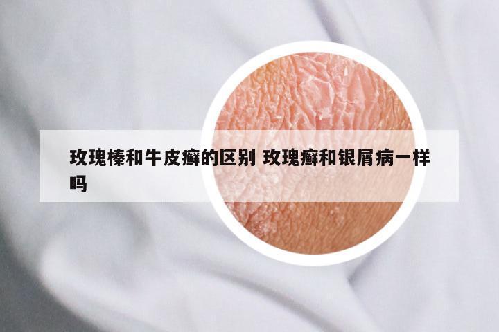玫瑰榛和牛皮癣的区别 玫瑰癣和银屑病一样吗
