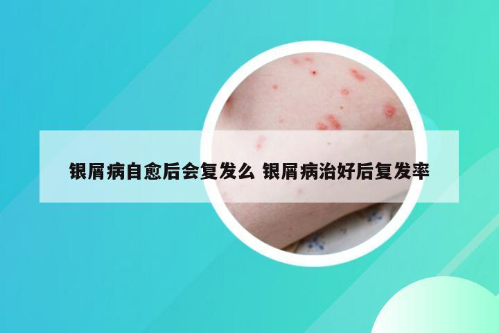 银屑病自愈后会复发么 银屑病治好后复发率