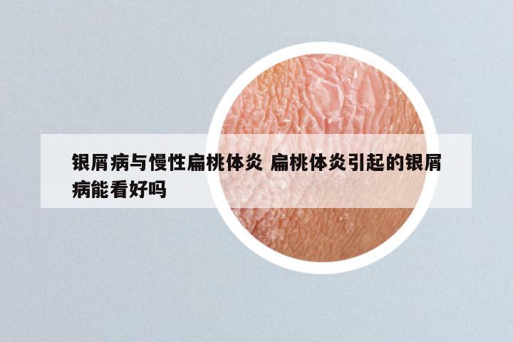 银屑病与慢性扁桃体炎 扁桃体炎引起的银屑病能看好吗