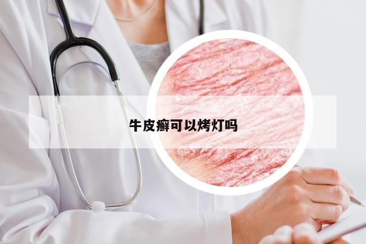 牛皮癣可以烤灯吗