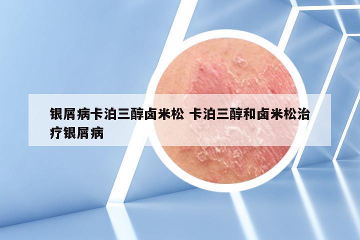 银屑病卡泊三醇卤米松 卡泊三醇和卤米松治疗银屑病