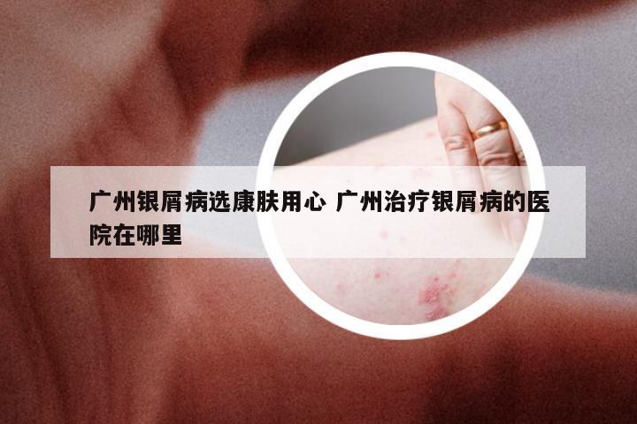 广州银屑病选康肤用心 广州治疗银屑病的医院在哪里