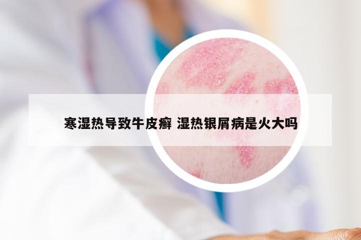寒湿热导致牛皮癣 湿热银屑病是火大吗