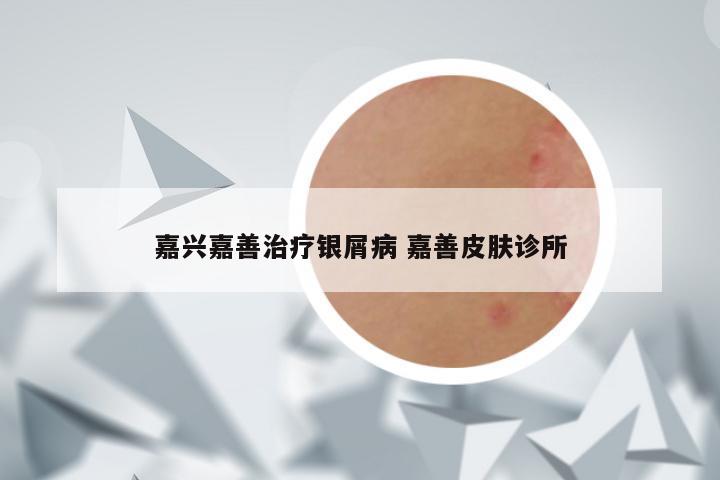 嘉兴嘉善治疗银屑病 嘉善皮肤诊所
