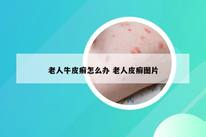 老人牛皮癣怎么办 老人皮癣图片