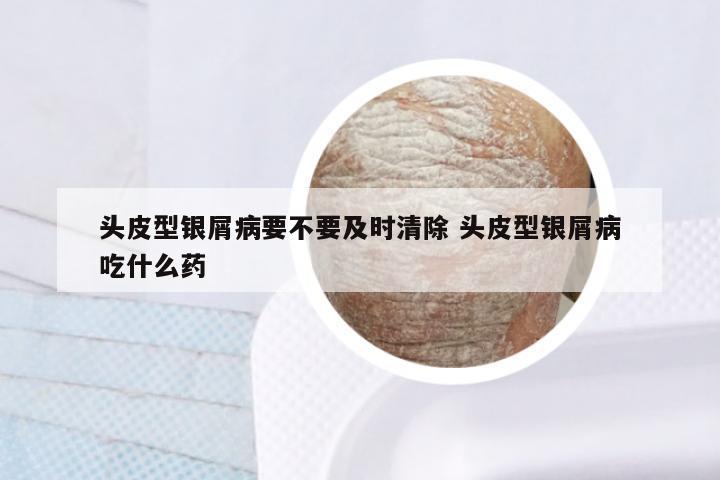 头皮型银屑病要不要及时清除 头皮型银屑病吃什么药