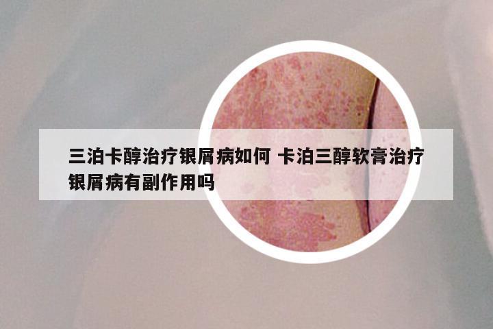 三泊卡醇治疗银屑病如何 卡泊三醇软膏治疗银屑病有副作用吗