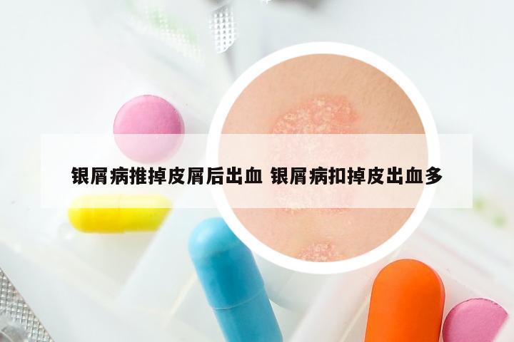 银屑病推掉皮屑后出血 银屑病扣掉皮出血多