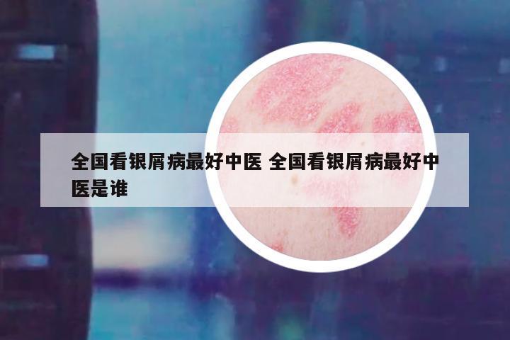 全国看银屑病最好中医 全国看银屑病最好中医是谁