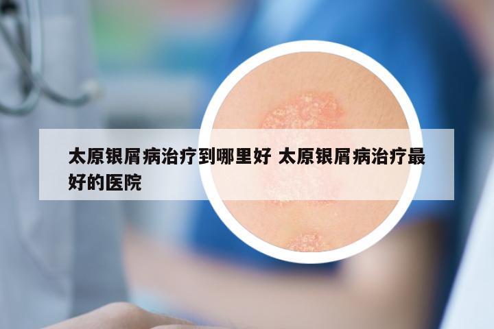太原银屑病治疗到哪里好 太原银屑病治疗最好的医院