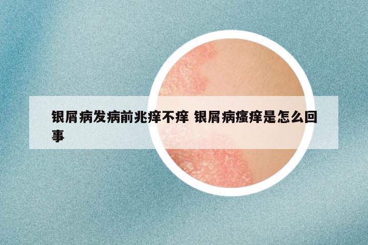 银屑病发病前兆痒不痒 银屑病瘙痒是怎么回事