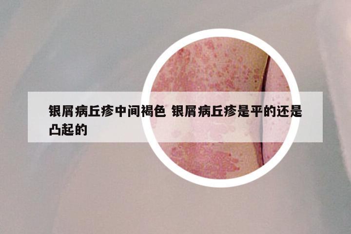 银屑病丘疹中间褐色 银屑病丘疹是平的还是凸起的