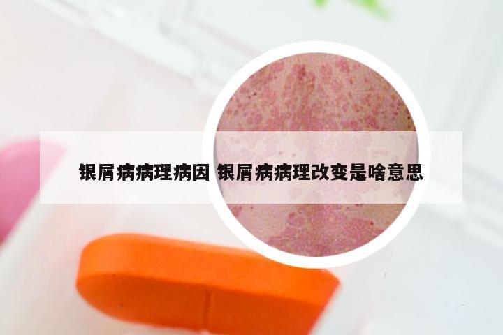 银屑病病理病因 银屑病病理改变是啥意思