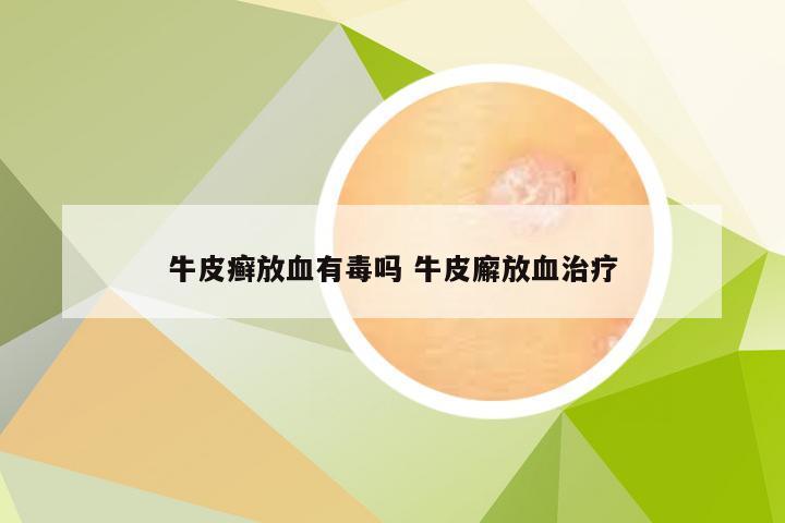 牛皮癣放血有毒吗 牛皮廨放血治疗