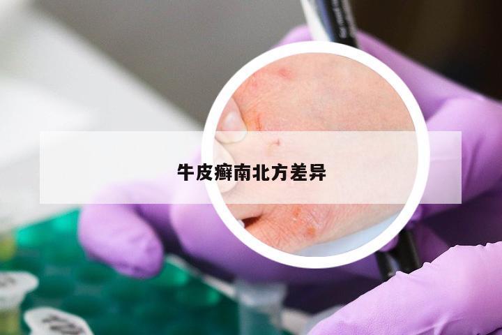 牛皮癣南北方差异
