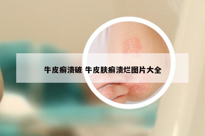 牛皮癣溃破 牛皮肤癣溃烂图片大全