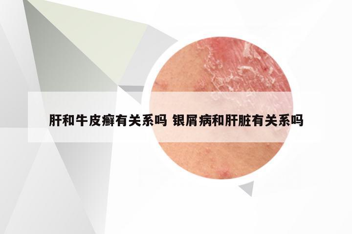 肝和牛皮癣有关系吗 银屑病和肝脏有关系吗