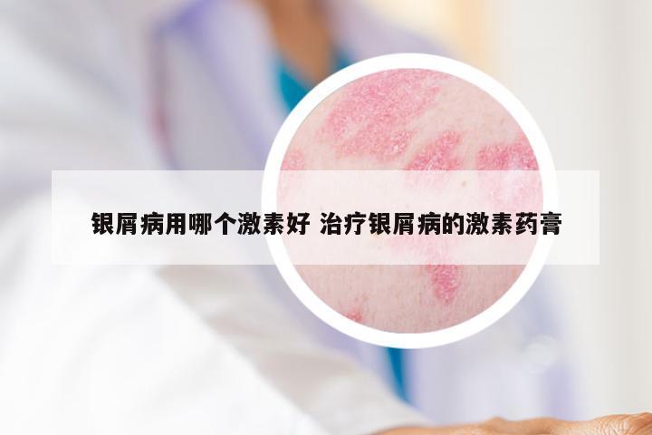 银屑病用哪个激素好 治疗银屑病的激素药膏