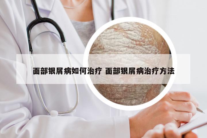 面部银屑病如何治疗 面部银屑病治疗方法