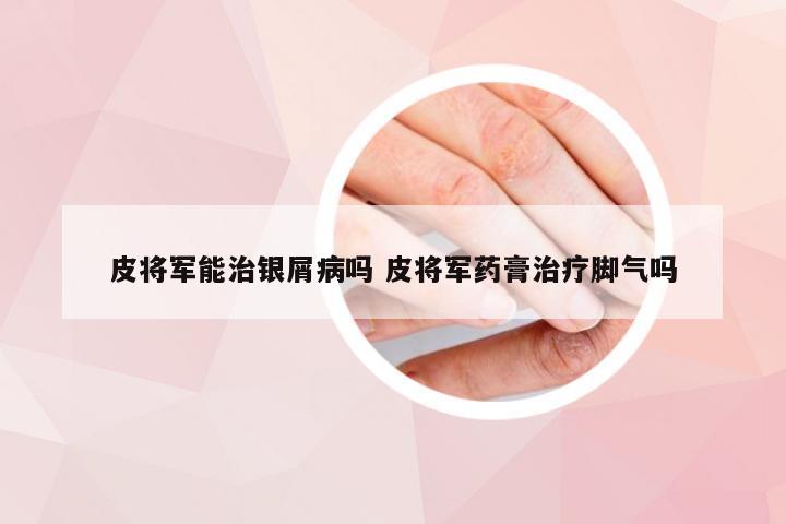 皮将军能治银屑病吗 皮将军药膏治疗脚气吗