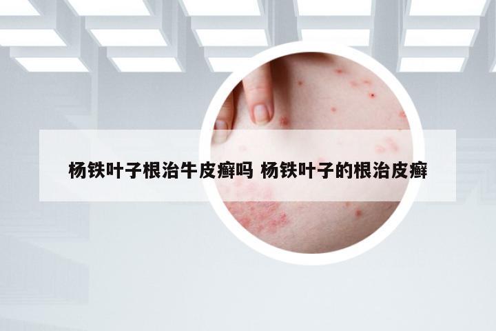 杨铁叶子根治牛皮癣吗 杨铁叶子的根治皮癣