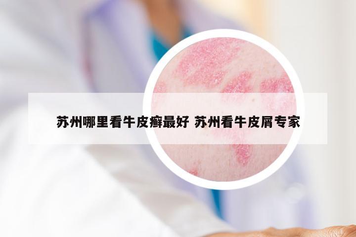 苏州哪里看牛皮癣最好 苏州看牛皮屑专家