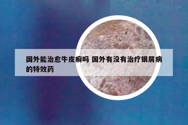 国外能治愈牛皮癣吗 国外有没有治疗银屑病的特效药