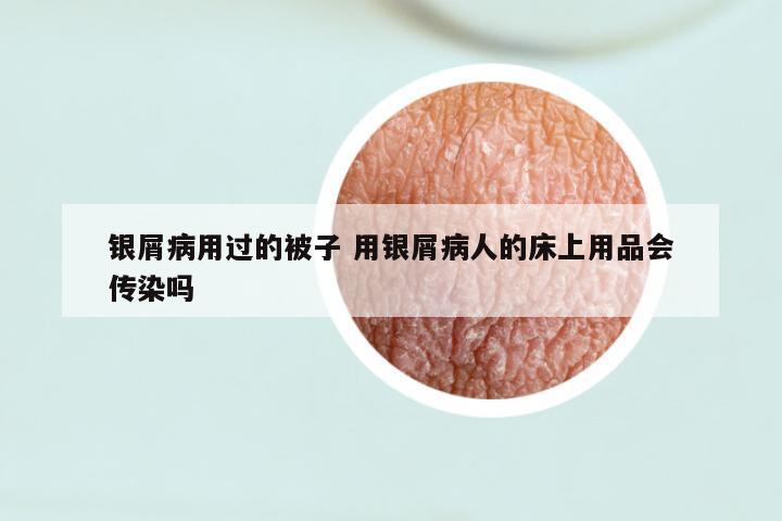 银屑病用过的被子 用银屑病人的床上用品会传染吗