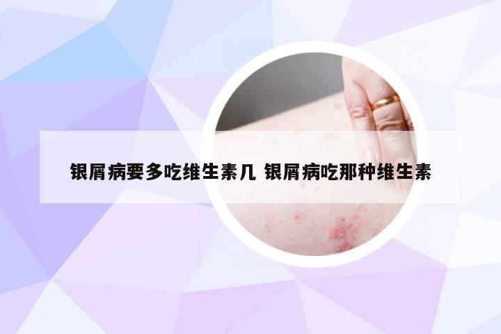 银屑病要多吃维生素几 银屑病吃那种维生素