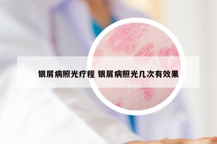 银屑病照光疗程 银屑病照光几次有效果